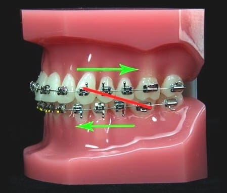 CLASS III Elastics: